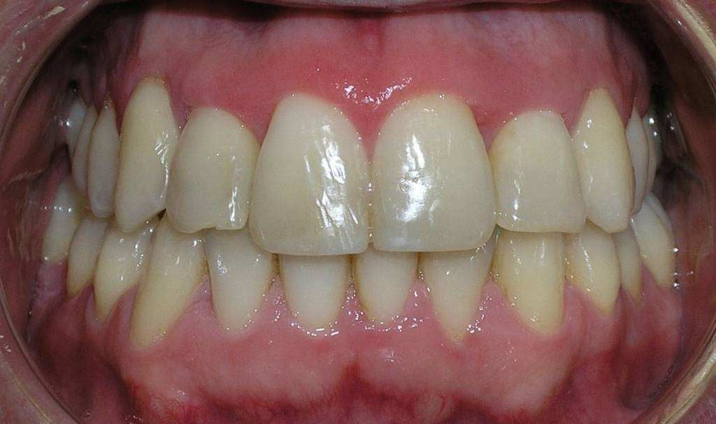 Boca después del tratamiento de ortodoncia, con los dientes alineados y los incisivos superiores por delante de los inferiores.